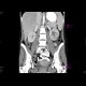 Acute pyelonephritis, left kidney: CT - Computed tomography